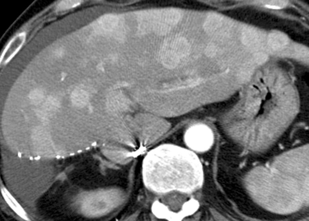 Transcatheter Arterial Chemoembolization in Recurrent HCC after Living Donor Liver Transplantation degree of portal venous thrombosis were evaluated by celiac and superior mesenteric angiography.
