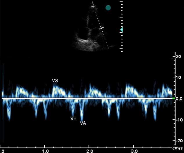 The upper panel shows the sample position used to record velocities from the basal lateral wall near the mitral annulus. The lower panel shows the velocity waveforms obtained.