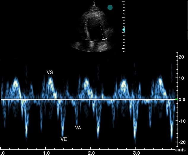 1323.e10 Bountioukos et al American Heart Journal June 2006 Figure 4 Pulsed-wave tissue Doppler of regional longitudinal motion in a patient without hypertension.