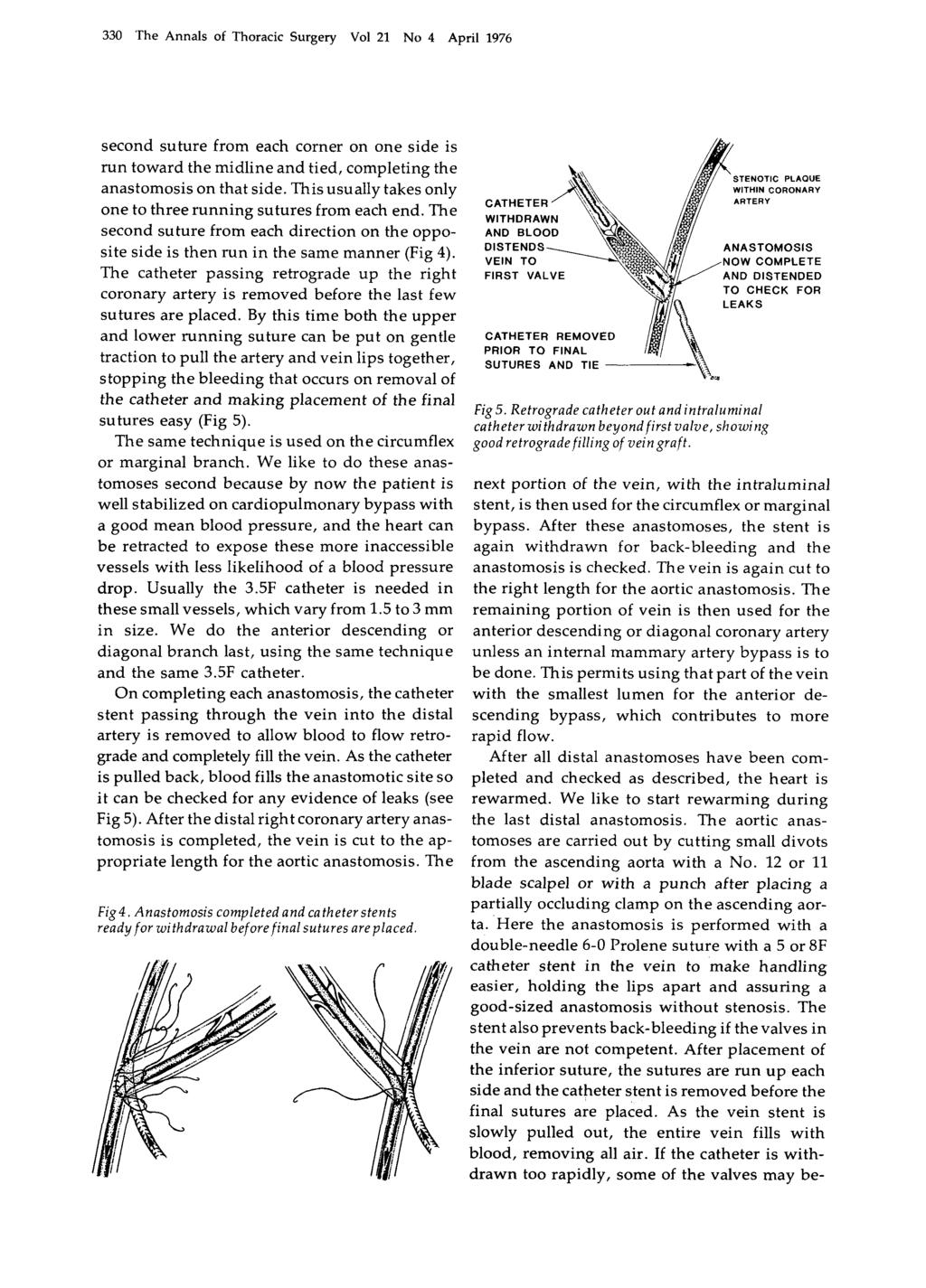 330 'The Annals of Thoracic Surgery Vol 21 No 4 April 1976 second suture from each corner on one side is run toward the midline and tied, completing the anastomosis on that side.