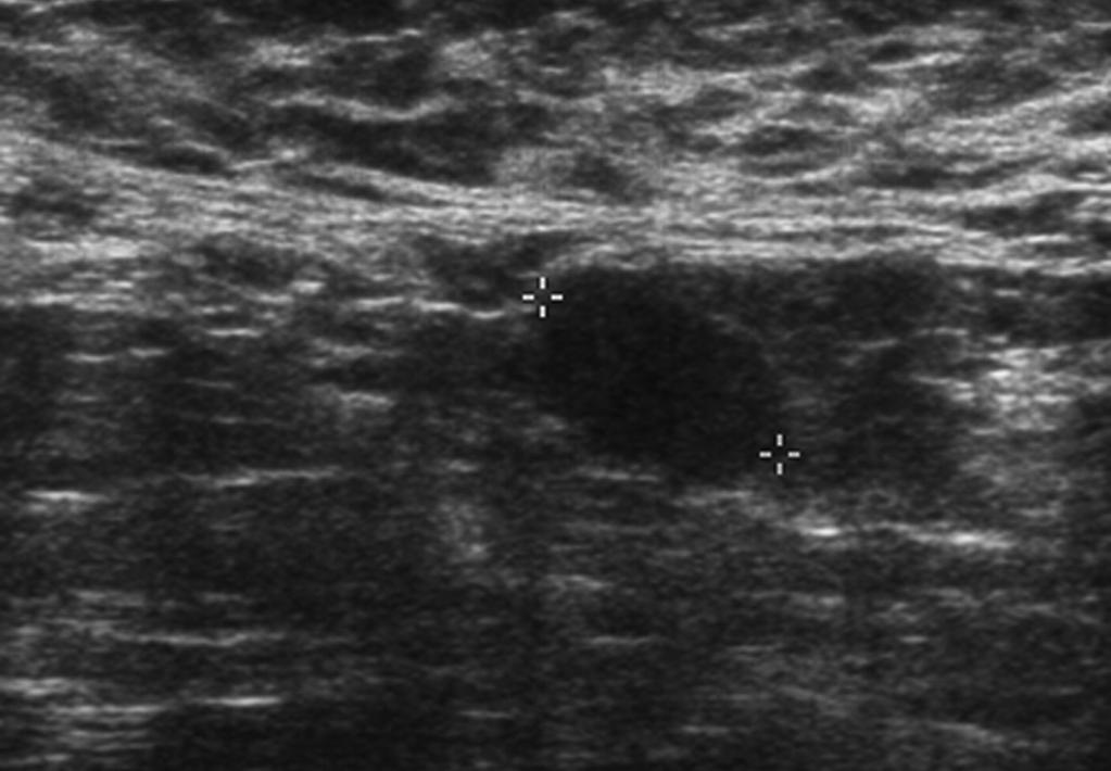 within the right upper outer quadrant. C. Abnormal lymph nodes without fatty hilum in the right axilla can be seen.