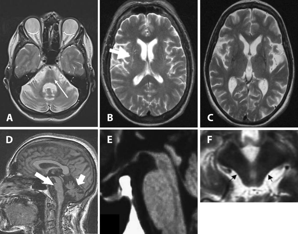 Magnetic resonance imaging for the diagnosis of Parkinson s disease 923 Fig.