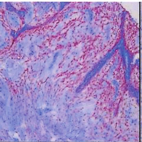 153 Immunohistochemical Phenotypes of Phyllodes Tumor noted in 15 (62.5%) of 25 cases, but none of the co-existent type showed a positive reaction for CD34.