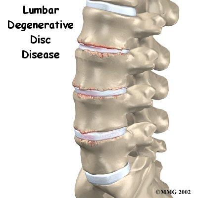 Lumbar Degenerative Disc Disease DDD is a