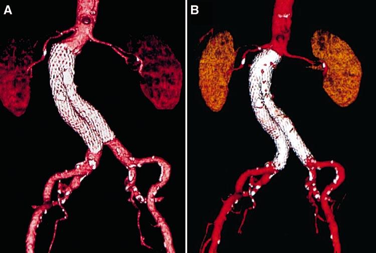 J ENDOVASC THER II-197 Figure 2Successful endovascular repair yesterday (A) and today (B).