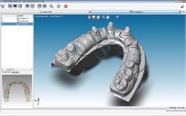 designing simple copings using the multi-die batch mode in about 1 min 15 sec - Scanning and designing full contour crown, using the axis finder in