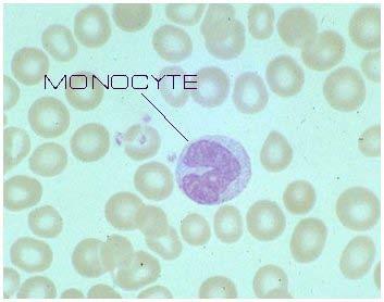 WBC Differential: Monocytes Possible Causes of Monocytosis: Common: recovery phase after infections Uncommon: certain infections (TB, malaria), inflammatory bowel disease Rare: