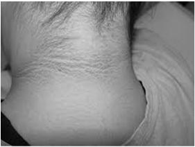 Acanthosis Nigricans PCOS A hot topic in adolescent