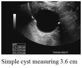 Ovarian cysts Ovarian cysts are common as the teenager has a more mature H-P-O axis 99%
