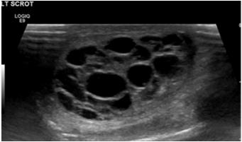 Girls with recurrent hemorrhagic cysts and ruptured cysts can benefit from OCPs An endometrioma or a dermoid cyst are