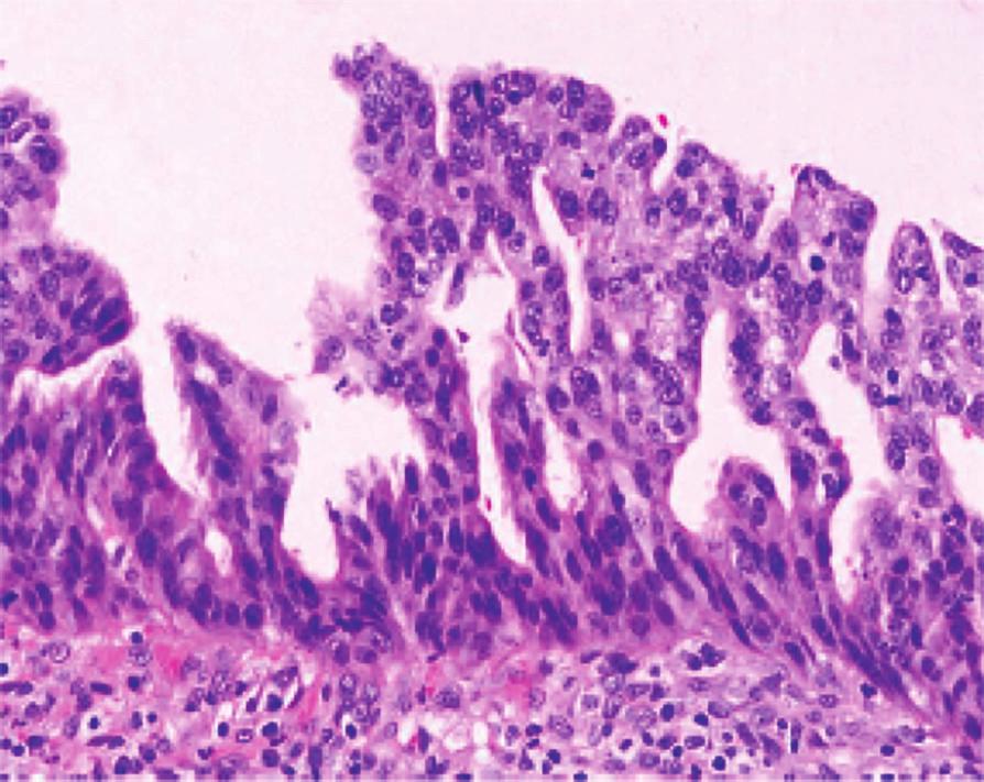 [2,4,13,25,26] Histological Aspect Histological variant of invasive carcinoma has major prognostic implications, and is therefore a significant part during the reporting of IPMN.