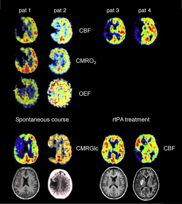 predicted poor outcome better than neurologic deficit scores, especially when the volume of perfusion deficit was considered, and correlated to infarct size on late CT scans (35).