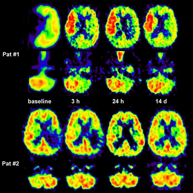 and neurologic deterioration during the first week after stroke are correlated.