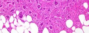 adenoneuroendocrine carcinoma EC cell, serotonin-producing NET L cell, glucagon-like peptide-producing and PP/PYY-producing NETs Goblet cell carcinoid (GCC) Tubular carcinoid Tubular Carcinoid