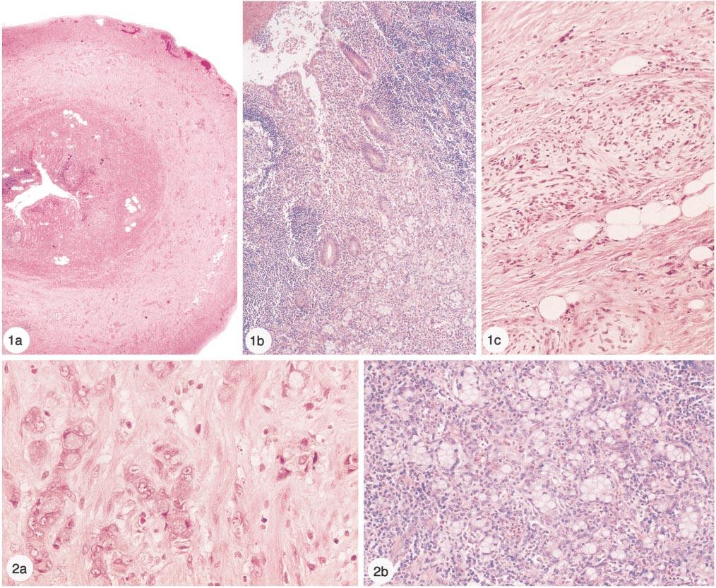 Figure 1. a and b, Acute appendicitis with a diffusely infiltrating goblet cell neoplasm (hematoxylin-eosin, original magnification 50 [a] and 125 [b]).
