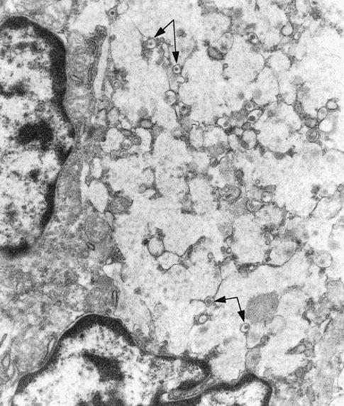 Figure 3. Electron microscopic examination reveals cells with abundant mucinous vacuoles and few electron-dense granules (arrow) (original magnification 19 750).