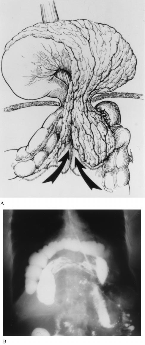 Boston: Little, Brown and Co., Inc, 1996.) (B) Contrast radiograph demonstrating herniation of stomach and transverse colon within the paraesophageal hernia sac (type IV hiatal hernia). Fig 3.