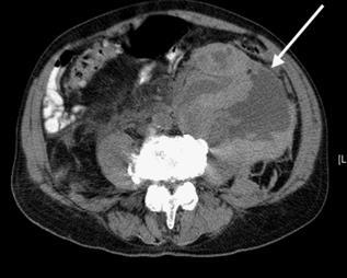 Retroperitoneal Hemorrhage Diagnosis: Non-contrast CT Treatment: Conservative Close hemodynamic