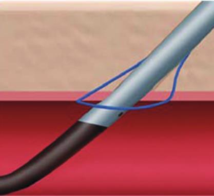 Proglide, Abbott 5-8 Fr Access Polypropylene monofilament suture Retains Knotted tensile