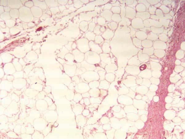 Figure 1. Photomicrograph of human fat, showing a channel produced by the fiber without laser irradiation (HES stain; original magnification 40).