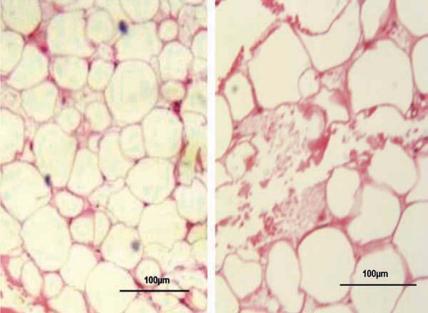 A B Figure 2. A, Normal adipocytes. Round-shaped adipocytes with a maximum diameter of 75 µm (range 30-75 µm). B, Tumescent adipocytes observed after irradiation with an Nd:YAG laser (6 J).