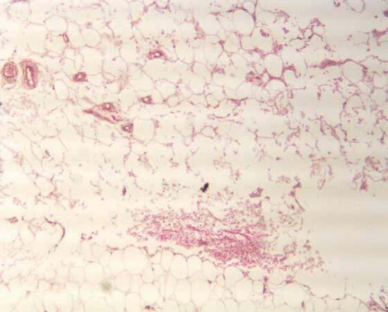 Figure 3. Photomicrograph of human fat in a laser-treated area (980-nm diode laser: 30 J) shows disruption of adipocyte membranes, coagulated collagen fibers, and blood vessel coagulation.