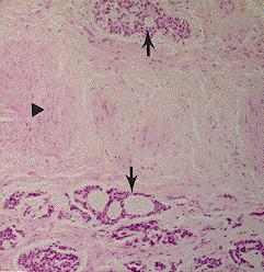 Adenoid cystic carcinoma with perineural invasion.