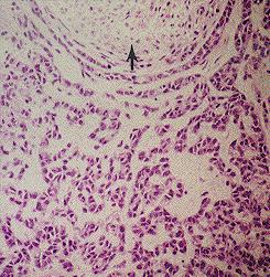 Adenoid cystic carcinoma, cords of cells and individual cells