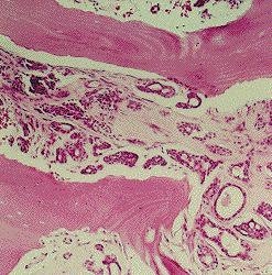 Adenoid cystic carcinoma, infiltrating bone of