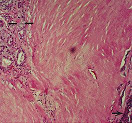 Adenoid cystic carcinoma, parotid, capsular invasion.