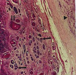 capsule. Adenoid cystic carcinomas are only poorly encapsulated at best.