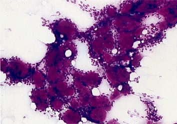 Adenoid cystic carcinoma. FNAB of a parotid mass.