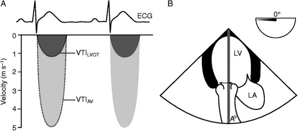 Q P /Q S normally equals 1 as the CO from left and right ventricles is equal. In the presence of a pathological shunt, Q P increases. The ratio is important as Q P /Q S >1.