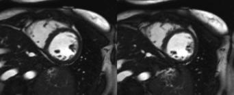 inflow May be more difficult to detect borders Ventricular volumes higher, myocardial mass lower on SSFP
