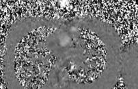 Vessel in center of FOV Lotz. RadioGraphics 2002; 22:651. Gatehouse.