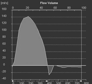 PC velocity imaging flow curve Phase contrast imaging max velocity/gradient Regurgitant fraction Backward flow/forward flow 0.2 l/min/2.