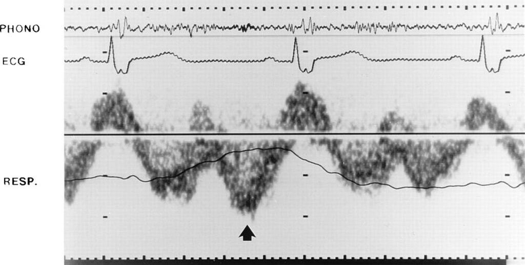apparent filling during atrial systole Transtricuspid Doppler
