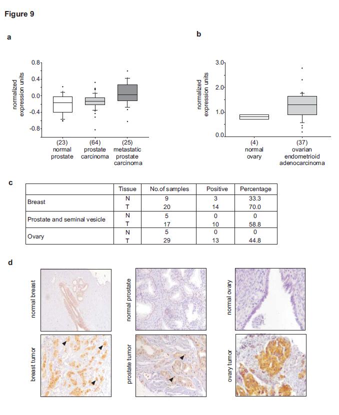 5. Copine III and ErbB2-mediated migration Figure 5-11 Expression of Copine III in breast, prostate and ovarian cancer samples (a and b) CPNE3 expression analysis in different microarray datasets