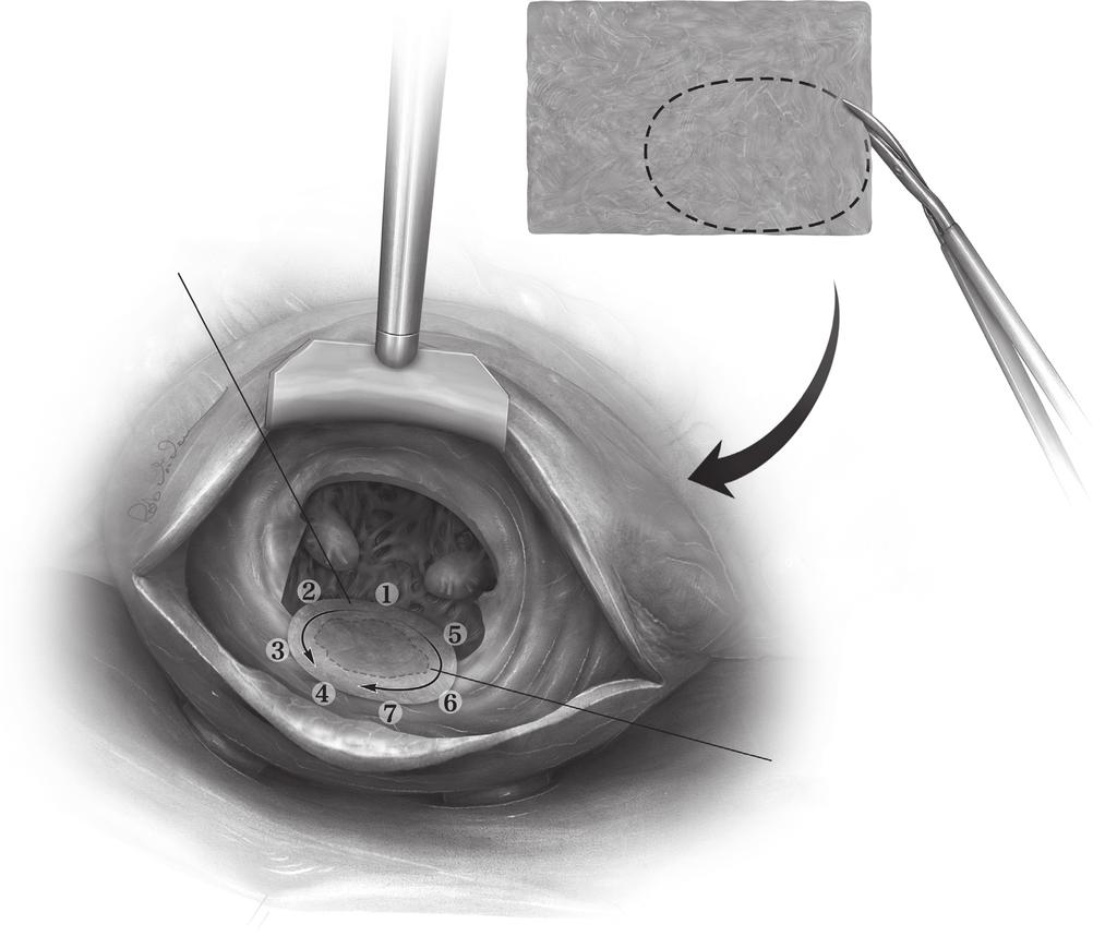 Mitral valve replacement for infective endocarditis with annular abscess 23 A Bovine pericardial patch trimmed to fit over defect Directional pattern for suturing patch Defect under patch Figure 4