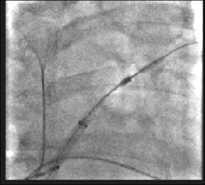 Techniques for AF ablation PV