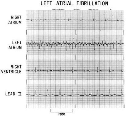AF treatment 1980 Cox left atrial isolation procedure Sinus rhythm