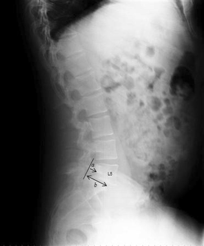 spondylolysis, a defect or fracture of the pars interarticularis of the vertebral arch, is the most common cause of spondylolisthesis.