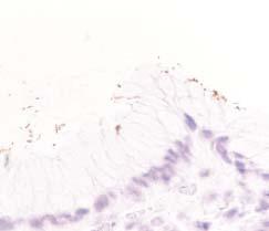 Goldstein / CHRONIC INACTIVE GASTRITIS AND COCCOID H PYLORI Image 5 Immunohistochemical stain, predominantly bacilliform Helicobacter pylori of different shapes.