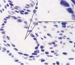 Inset, Computer-enlarged image (diaminobenzidine counterstain, 192). Image 8 Immunohistochemical stain, coccoid Helicobacter pylori (diaminobenzidine counterstain, 224 with oil immersion lens).