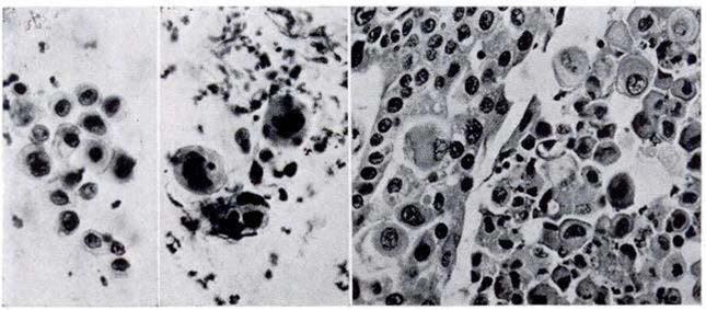 One condition in which exfoliated cells may appear in clusters Figure 7 a and 7 b, Case L593: Photographs of x-ray plates showing infiltrative process in base of right lung.