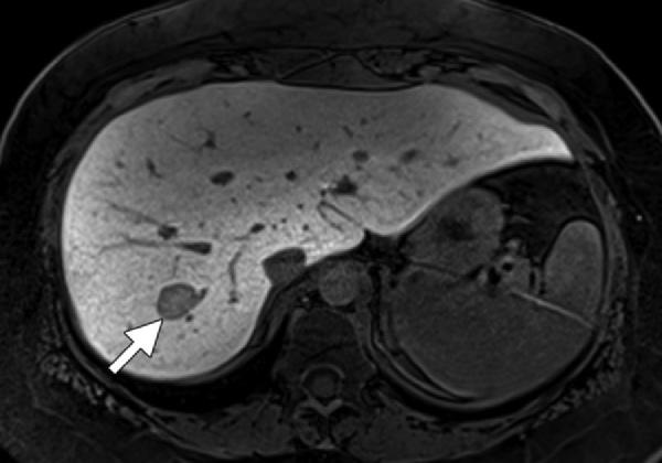 RG Volume 31 Number 6 Goodwin et al 1557 Figure 12. Histologically proved solitary hepatic adenoma with typical hepatocellular phase features in a 35-year-old woman.