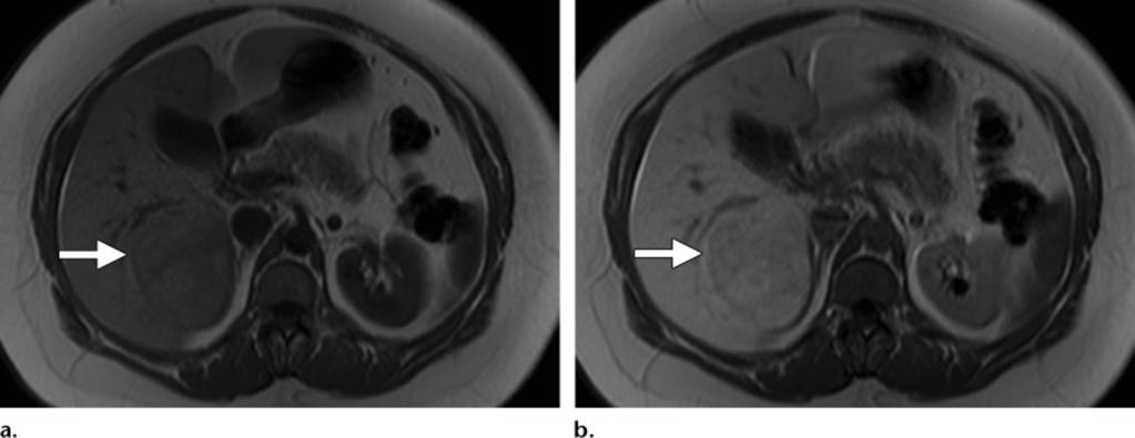 (b, c) Axial T1-weighted non fatsaturated images obtained before (b) and during the hepatocellular phase 10 minutes after (c) gadoxetic acid injection show mild hyperintensity of the lesion relative