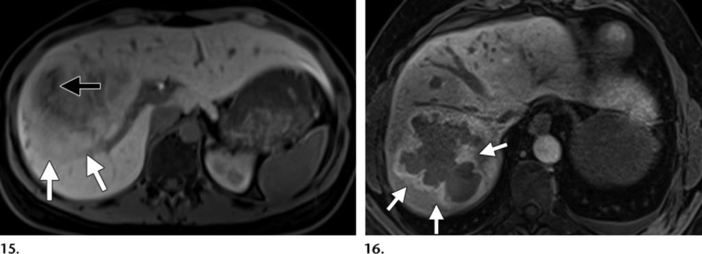 enhancing hepatic adenoma with an atypical appearance.
