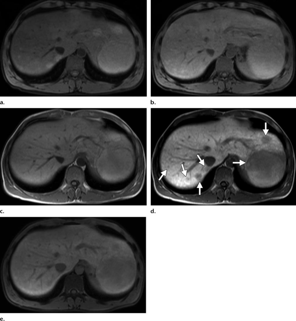 RG Volume 31 Number 6 Goodwin et al 1567 Figure 24. MR imaging examinations performed with gadoxetic acid and gadobenate dimeglumine in a 32-year-old man with hepatic steatosis.