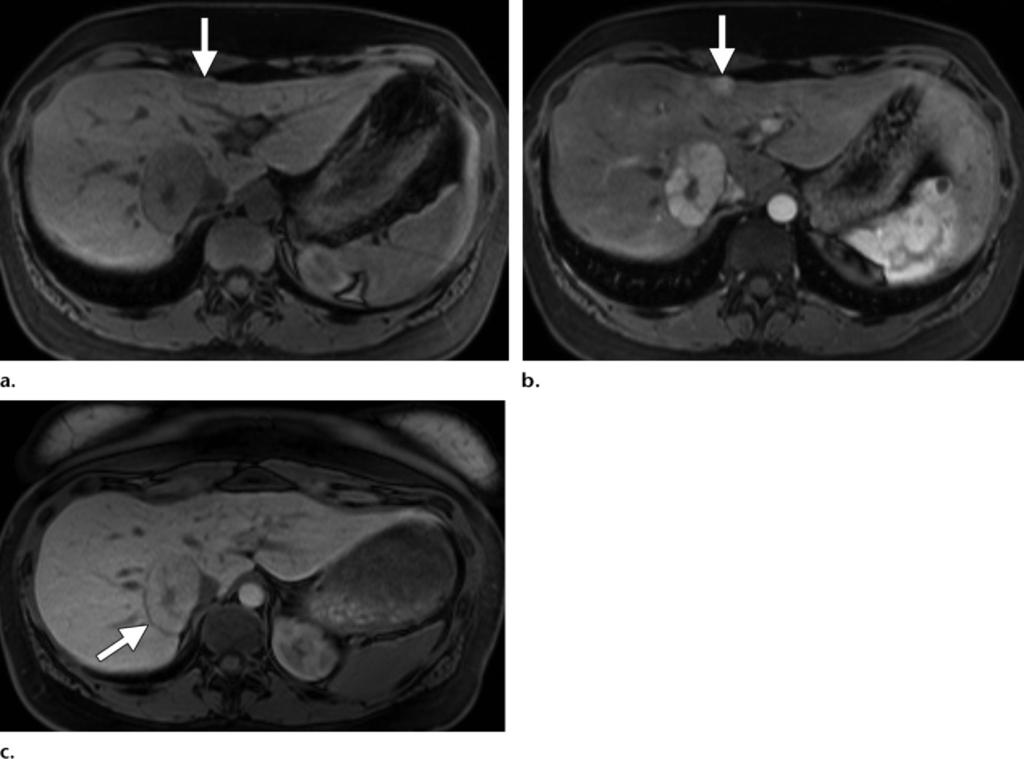 RG Volume 31 Number 6 Goodwin et al 1553 Table 2 Signal Intensity Patterns in Common Liver Lesions with Standard MR Imaging and Hepatocellular Phase Imaging with HSCAs Hepatic Lesion Unenhanced T1